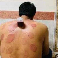 حجامت، فصد خون، تزریقات، بخیه|خدمات آرایشگری و زیبایی|اهر, |دیوار