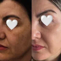 بوتاکس /ضدلک/رفع چین وچروک