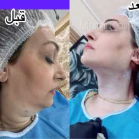 تزریق ژل و بوتاکس-چربی|خدمات آرایشگری و زیبایی|اهواز, کیانپارس |دیوار