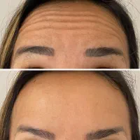 پزشک مزو ژل بوتاکس لب گونه چشم چانه زاویه فیلر prp|خدمات آرایشگری و زیبایی|کرج, گوهردشت|دیوار