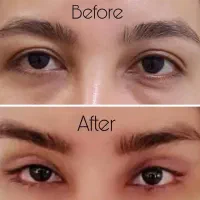 بلفاروپلاستی لیفت صورت بوکال فت تزریق چربی|خدمات آرایشگری و زیبایی|کرمانشاه, |دیوار