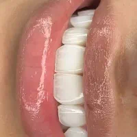 کامپوزیت، لمینت، ایمپلنت دندان اقسا*طی|خدمات آرایشگری و زیبایی|مشهد, شریف|دیوار