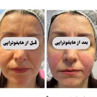 بمب تخفیف هایفوتخصصی صورت و واژن توسط پزشک درمطب