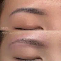 پاک کردن تتوی صورت و بدن بانوان و آقایان