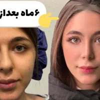 جراحی بینی با تخفیف باورنکردنی 50درصد|خدمات آرایشگری و زیبایی|قرچک, شهرک طلائیه|دیوار