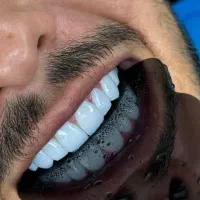 لمینت۸۹۰۰/کامپوزیت۷۹۰/مدل/روکش۶۹۰۰|خدمات زیبایی و سلامت|تهران, سازمان برنامه شمالی|دیوار