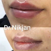 فیلر/بوتاکس/ قسطی کلینیک زیبایی دکتر نیک جان|خدمات آرایشگری و زیبایی|رشت, گلسار|دیوار