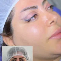 تخفیف ویژه عمل افتادگی پلک بلفاروپلاستی نقدو اقساط|خدمات آرایشگری و زیبایی|تهران, تهرانسر مرکزی|دیوار