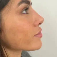 فیلر ژل لب تخصصی بوتاکس پزشک کلینیک زیبایی|خدمات آرایشگری و زیبایی|تهران, تهرانسر مرکزی|دیوار