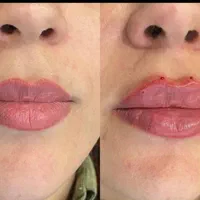 اموزش و تزریق ژل بوتاکس