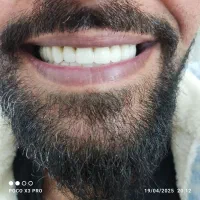 ساخت تخصصی دندان مصنوعی(دندانسازی) (اقساط 6 ماه)|خدمات آرایشگری و زیبایی|قم, شاه ابراهیم|دیوار
