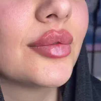 خدمات مزو وژل وبوتاکس با ۶سال سابقه کار