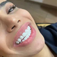 آف ویژه خدمات تخصصی کامپوزیت دندان|خدمات آرایشگری و زیبایی|شاهین‌شهر, فردوسی|دیوار