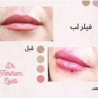 فیلر، بوتاکس، جوانساز|خدمات آرایشگری و زیبایی|تهران, کوی بیمه|دیوار