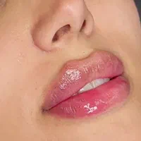 فیلر۶۰۰زیبایی صورت.لب با ژل/رفع چروک بابوتاکس۷۰۰