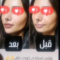 تزریق فیلر به روش mdcodes|خدمات آرایشگری و زیبایی|اسلام‌شهر, شهرک واوان|دیوار