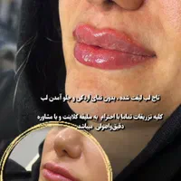 لیزر موهای زاید تزریق بوتاکس وژل  توسط پزشک|خدمات آرایشگری و زیبایی|تالش, هشتپر|دیوار