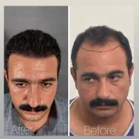 کاشت مو پرپشت بااولین تیم‌ شیرازی دریزد(کادردرمان)