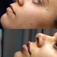 مدل ویژه ژل و بوتاکس فقط هزینه مواد
