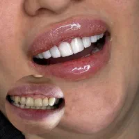 کامپوزیت،لمینیت،روکش،بلیچینگ در دندانپزشکی کیانمهر|خدمات آرایشگری و زیبایی|کرج, کیانمهر|دیوار