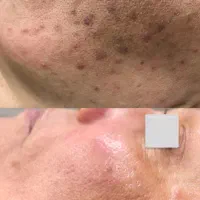 پاکسازی ۱۲مرحله با هدیه درما ۱۹۸ تومان( کلینیک)|خدمات آرایشگری و زیبایی|بیرجند, |دیوار