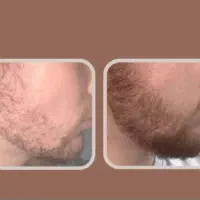 بالای ۱۸سالته و هنوز ریش نداری