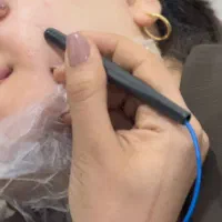 الکترو لیز رفع موهای سفید و مشکی. خالبرداری