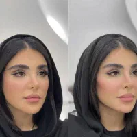 ژل ،بوتاکس، کوچک کردن بینی ،جوانسازی در کیلینیک|خدمات آرایشگری و زیبایی|کرمانشاه, |دیوار