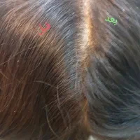 پاکسازی مو از رشک فقط و فقط در یک جلسه تضمینی