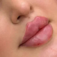 فیلر،بوتاکس آنزیم
