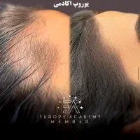 اسکالپ کف سر برای ریزش شدید  پر دیده شدن بدون کاشت