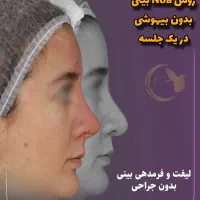 آف رینوپلاستی بینی بدون عمل جراحی NOA پزشک زیبایی|خدمات آرایشگری و زیبایی|مشهد, هفت تیر (آب و برق)|دیوار