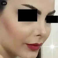 جراحی زیبایی عمل بینی ۳۵ لیپو ابدو 85لیفت 70 مامو