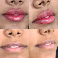 جشنواره بوتاکس و فیلر ویژه آخرسال