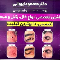 برداشت تخصصی انواع خال، زگیل و میخچه دکتر ایروانی