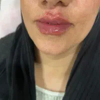 ژل سی سی۱۵۰۰ تومان ، آنزیم۱۳۰۰، بوتاکس۱۳۰۰ در مطب