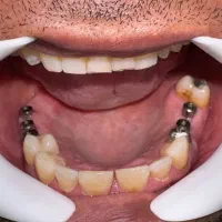 ایمپلنت دیجیتال اقساطی بدون سود در انواع برندها