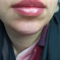 ژل بوتاکس زیبایی بینی لیفت صورت و بدن|خدمات آرایشگری و زیبایی|مشهد, هفت تیر (آب و برق)|دیوار