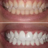 جشنواره بلیچینگ دو فک