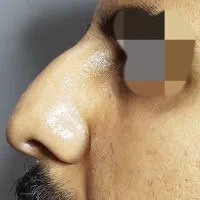 اصلاح فرم بینی بدون جراحی|خدمات آرایشگری و زیبایی|رشت, بلوار گیلان|دیوار