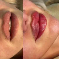 کلینیک تزریق ژل لب روسیm مادلینگ mdبوتاکس لیزر|خدمات آرایشگری و زیبایی|تهران, صادقیه|دیوار