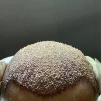 جشنواره ویژه کاشت تخصصی موشیرازی ۸میلیون باضمانت|خدمات زیبایی و سلامت|تهران, پاسداران|دیوار