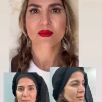 سوپر لیفت ابرو شقیقه و صورت در ۲۰دقیقه توسط پزشک