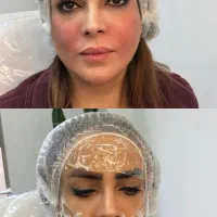 تخفیفات بلک فرایدی تزریق فیلر و بوتاکس رایگان