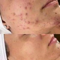 جشنواره فیشیال فوق تخصصی،هایفو،پلاژن،میکرونیدلینگ|خدمات آرایشگری و زیبایی|قم, سالاریه|دیوار