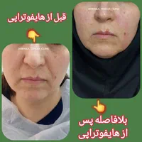** جوانسازی پوست با هایفو تنها ۹۸۰ هزار **|خدمات آرایشگری و زیبایی|تهران, نازی‌آباد|دیوار