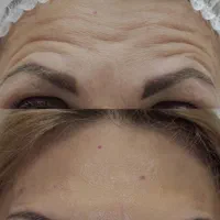 خدمات زیبایی صورت مزوتراپی بوتاکس فیلر|خدمات آرایشگری و زیبایی|شهریار, شهریار|دیوار