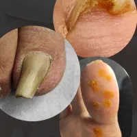 درمان بیماری های ناخن و ارتونیل (پودولوژی)|خدمات زیبایی و سلامت|اصفهان, نقش جهان|دیوار