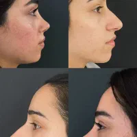 جشنواره عمل زیبایی بینی با تخفیف ویژه|خدمات آرایشگری و زیبایی|سقز, |دیوار