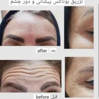 ژل و بوتاکس و برداشتن خال|خدمات آرایشگری و زیبایی|اهواز, زرگان|دیوار